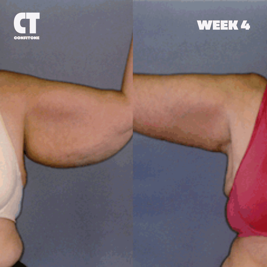 Week 4 results - side by side arm comparison showing visible improvement